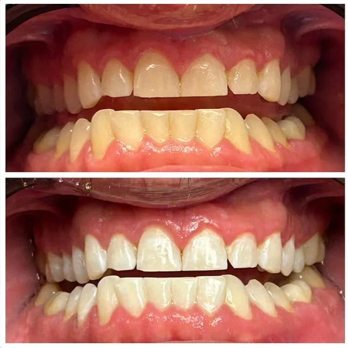 Dental Work Case 4 - Cosmetic Smile Rejuvenation